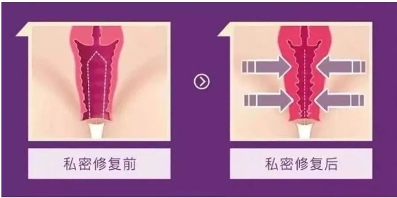 3D生物束帶緊縮術